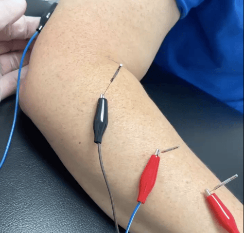 dry needling